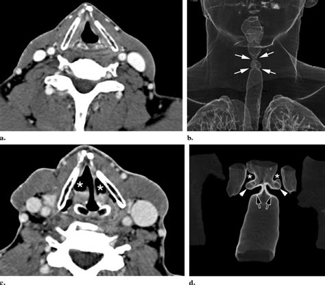 Normal Larynx A Axial Ct Scan Shows The Normal Appearance Of The