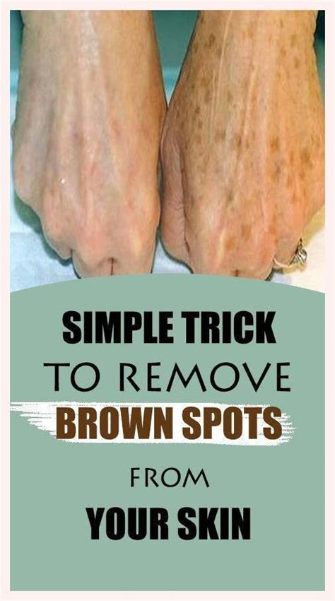 Simple Trick To Remove Brown Spots From Your Skin Sun Spots On Skin