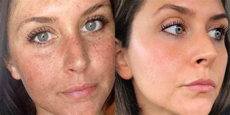 Apple Cider Vinegar For Melasma Recipes Review And Notes During