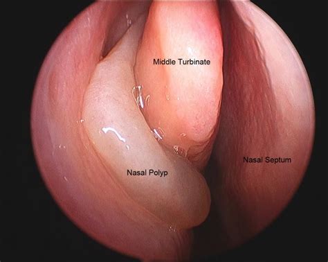 Nasal Polyps Causes Symptoms Treatment And Prevention