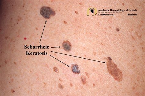 Self Removal Of Seborrheic Keratosis Seborrheic Dermatitis Seborrheic