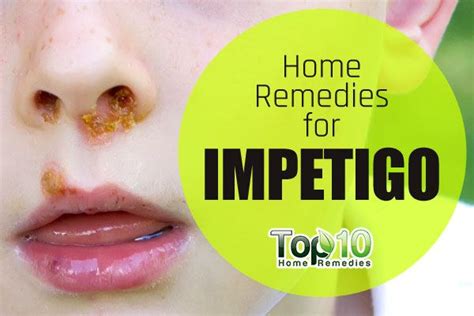Ideas 40 Of Home Remedies For Impetigo Heyhey Princessxing