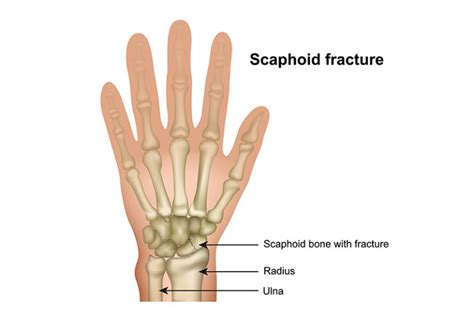 Scaphoid Fracture Direct Orthopedic Care