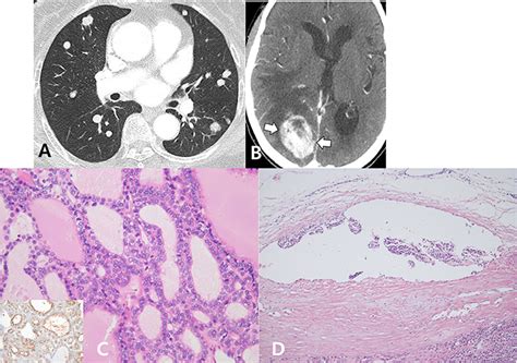 Frontiers Unexpected Lung And Brain Metastases 9 Years After Thyroid