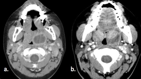 Peritonsillar Abscess A Axial Contrast Enhanced Ct Neck Shows