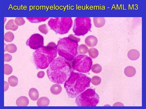 Ppt Leukemia Cll Rai Stage Survival Leukemia Lymphocytic Chronic Ppt