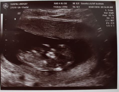 Adventures In Baby Making 12 Weeks Ultrasound