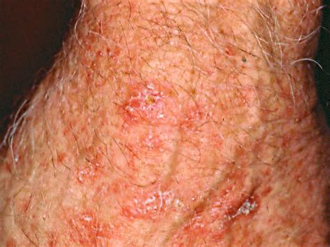 Is It Skin Cancer Cbs News
