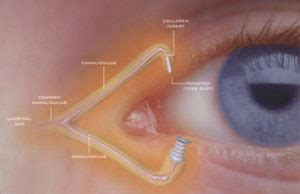 Punctal Plugs Specialized Eye Care