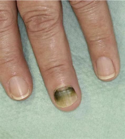Green Nail Syndrome Pseudomonas Aeruginosa Nail Infection Two Cases Successfully Treated With