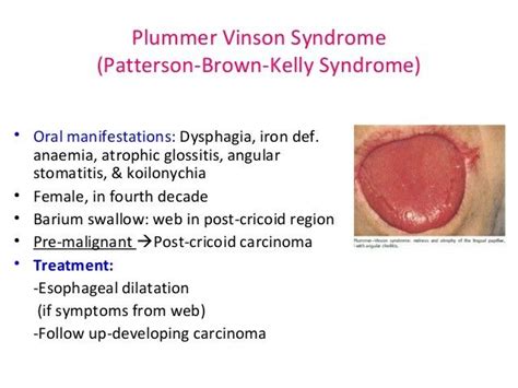 Plummer Vinson Patterson Brown Kelly Syndrome Oesophageal Web