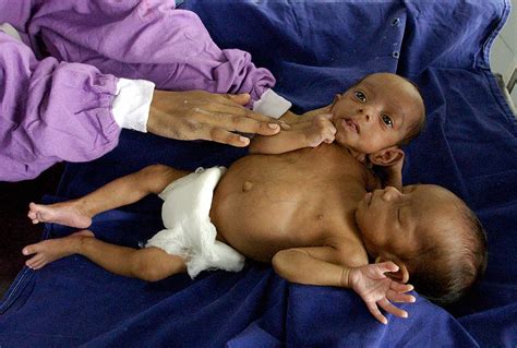 can conjoined twins live normally 19 year old indian men sharing one body gets first job with