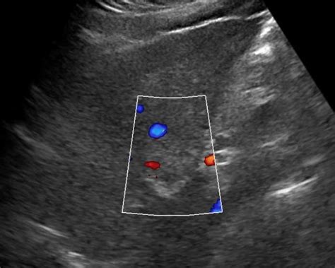 Liver Hemangioma Ultrasound Images