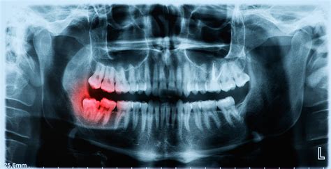 Panoramic X Ray Image Of Teeth And Mouth With Wisdom Teeth Parkview