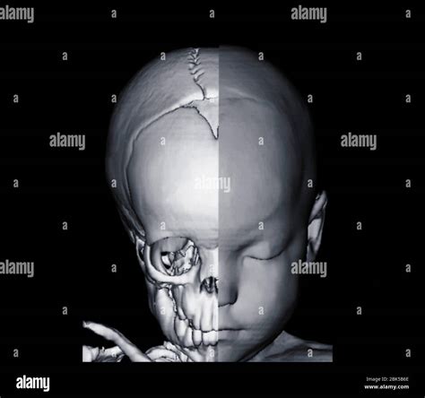Infant Skull Hi Res Stock Photography And Images Alamy