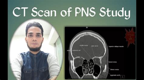Ct Scan Of Pns Coronal View Filming Text Study Youtube