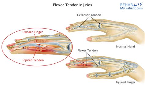 Flexor Tendon Injuries Rehab My Patient