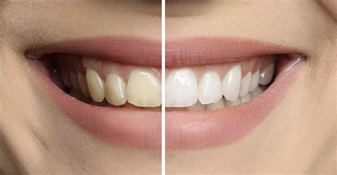 Teeth Whitening Camden Place Dental Practice Preston