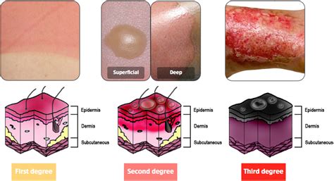 Degrees Of Burns Emergency Medicine Dermatology Reviews