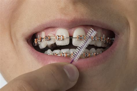 How To Guide For Braces And Invisalign Aligners Wilkinson Orthodontics