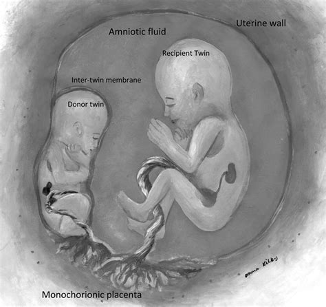Management Of Twin To Twin Transfusion Syndrome Adc Fetal And Neonatal
