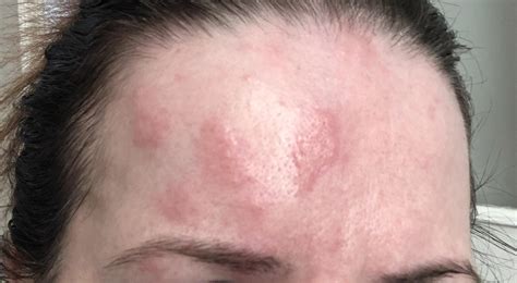 What Are The Symptoms Of Shingles On The Scalp