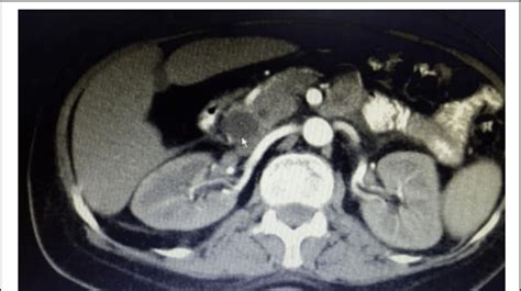 The Axial Cut Of The Intravenously And Orallyenhanced Abdominopelvic Ct