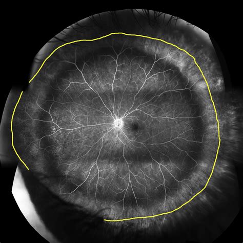 Ultra Widefield Imaging Of The Peripheral Retinal Vasculature In Normal