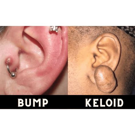 The Differance Between Piercing Bumps And Keloids Riri Accessory