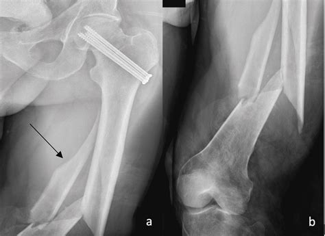 Cureus Perforation Of The Knee Joint Following Antegrade