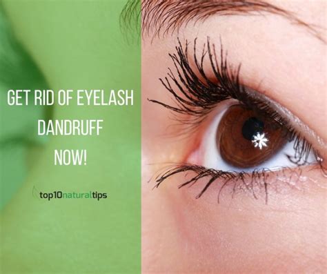 How To Remove Eyelash Dandruff 10 Must Try Easy Home Remedies