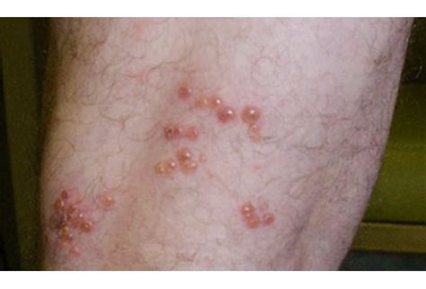 Burning Pain With A Spreading Rash And Blisters Case Quiz