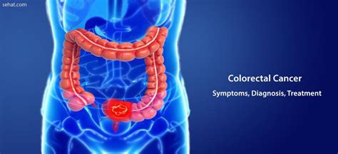 Colorectal Colon Cancer Symptoms Treatment Diagnosis