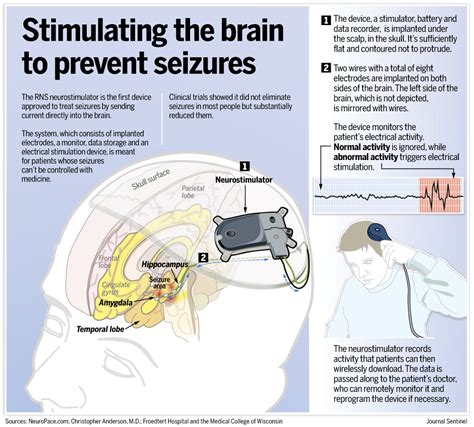 For Epilepsy Patient Brain Stimulation Offers Jolt Of Hope