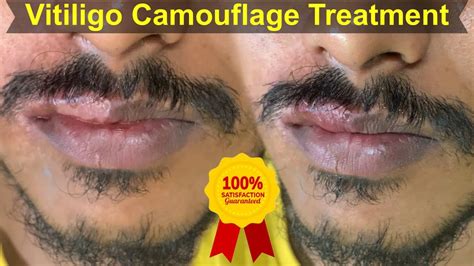 Lip Vitiligo Cure Permanent Solution Machu Tattoo Studio Bangalore