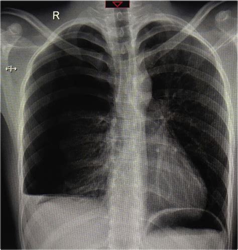 Initial Chest X Ray Posterior Anterior View Showed Right Apical
