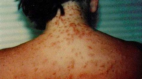 Sea Lice Are Leaving Some Florida Beachgoers With A Nasty Red Itchy Rash