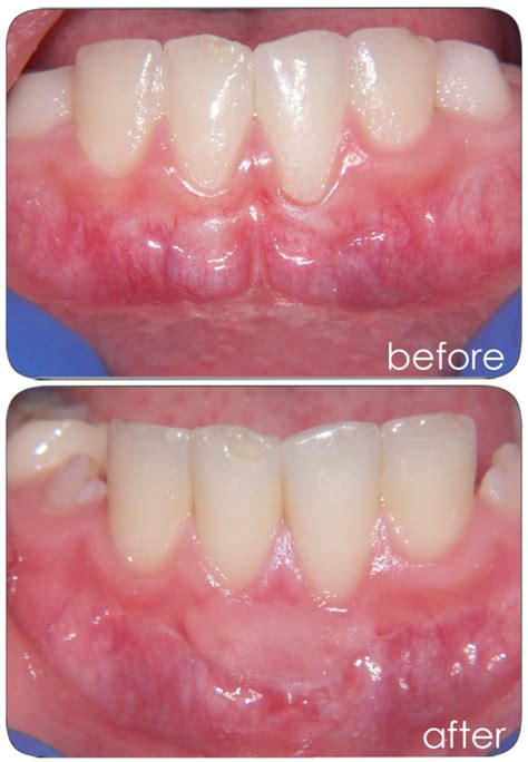 Free Gingival Graft Lake Charles LA Raymond J Steiner DDS