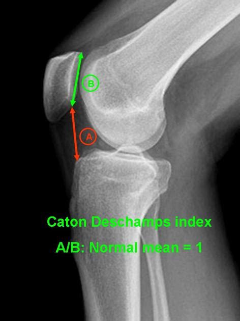 Caton Deschamps index | Radiology Case | Radiopaedia.org