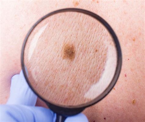 How To Spot This Potentially Deadly Skin Cancer Future Of Personal Health