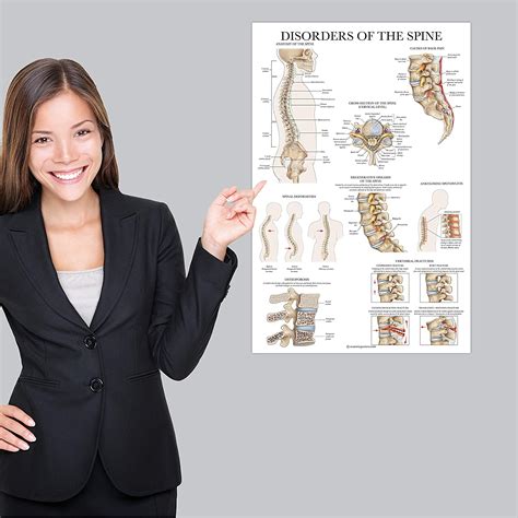 Buy Disorders Of The Spine Anatomy Poster Laminated Spinal Disorders