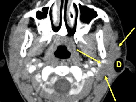 Dermoid Cyst Mri Online