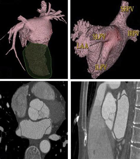 Three Dimensional Reconstruction Of The Left Atrium La Left