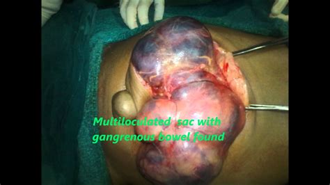 Large Strangulated Ventral Hernia With Bowel Gangrene Youtube