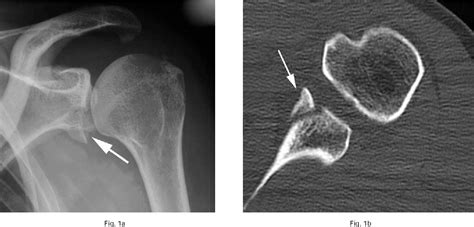 Figure 1 From Non Operative Treatment Of Large Anterior Glenoid Rim