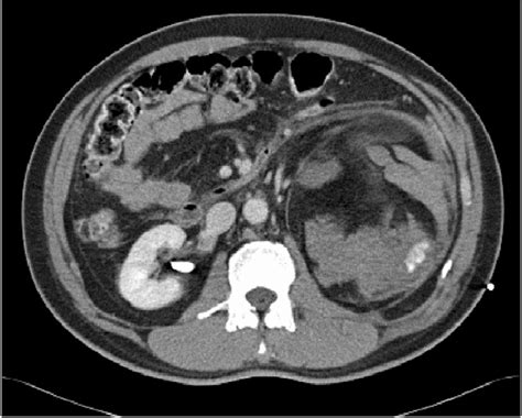 Ct Angiogram Showing Active Extravasation Of Contrast From Inferior
