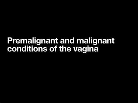 Gynecology Premalignant And Malignant Diseases Of Vagina YouTube