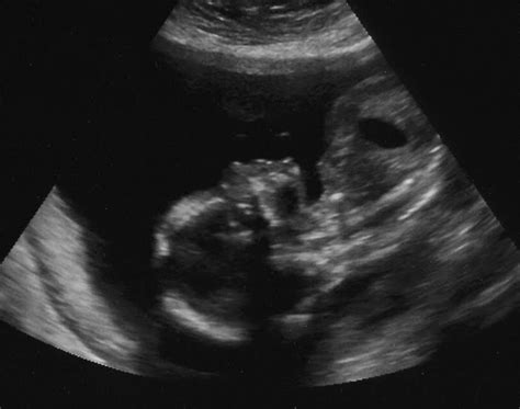 Adbanasa 3d Ultrasound 20 Weeks Boy