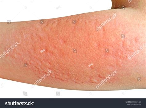 Skin Rashes Allergies Contact Dermatitis Allergic Foto Stock 1710629428
