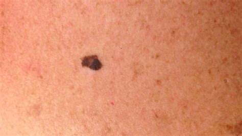 Pictures Of Skin Cancer On Back The Meta Pictures